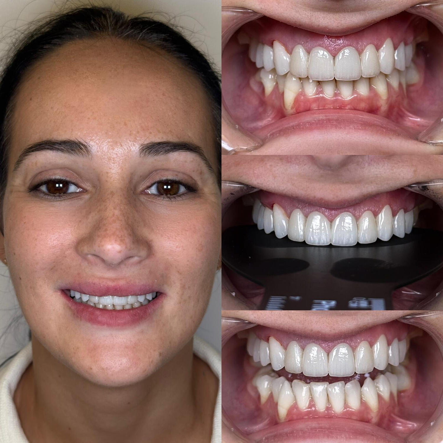 Transformări care redau încrederea în zâmbet ✨ Transformări care redau încrederea în zâmbet ✨