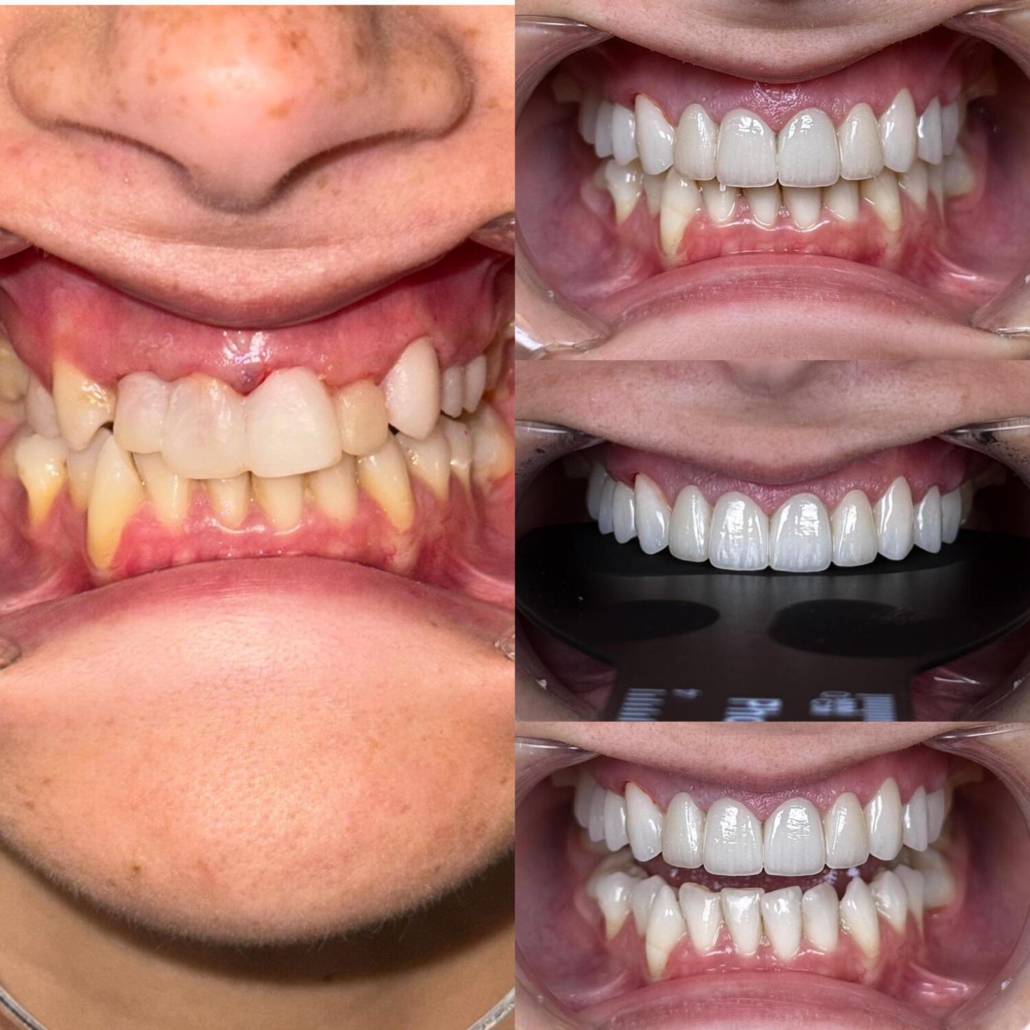 Reabilitare orala complexa coroane si fatete de zirconiu Reabilitare orala complexa coroane si fatete de zirconiu